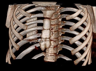 Göğüs Travmaları Belirtileri ve Tedavisi